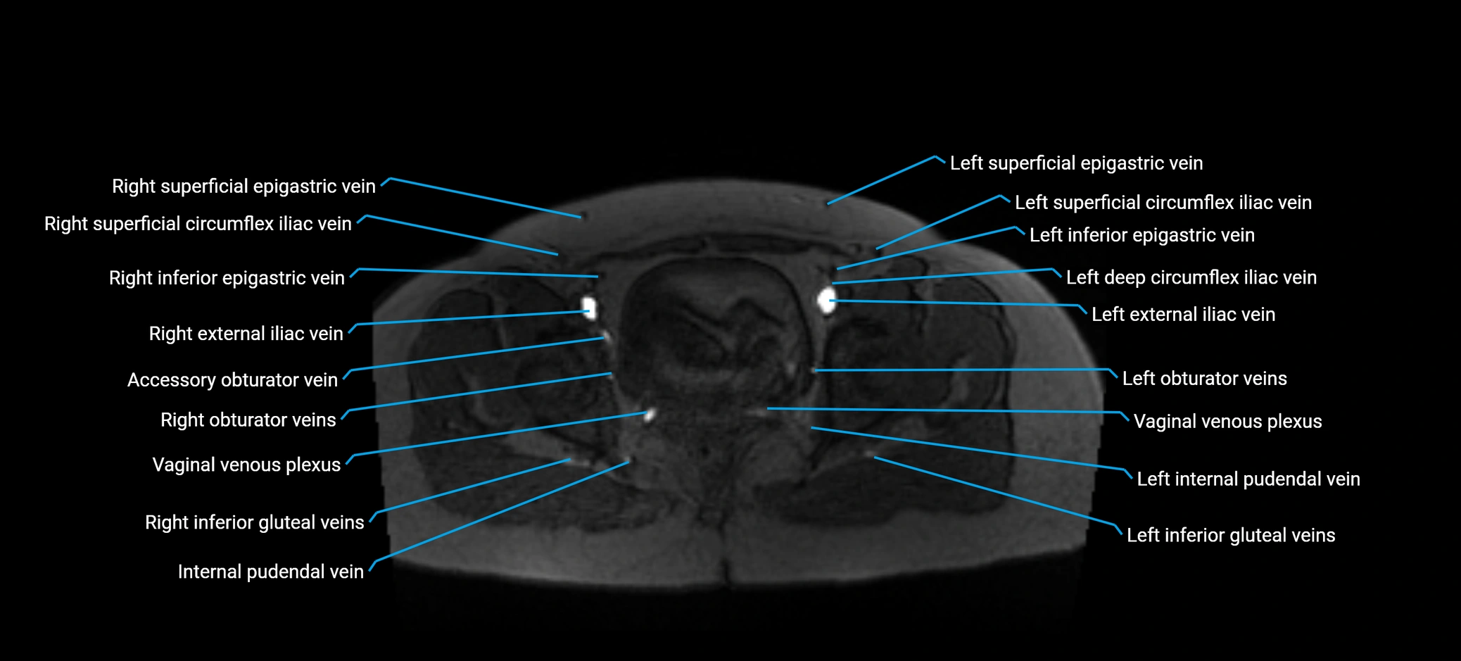 MRV abdomen pelvis & lower limb axial cross sectional anatomy labelled MRI image 176 (1).webp